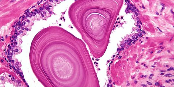 Squamous cell carcinoma of the lung