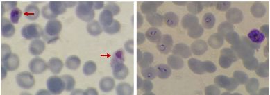 Computers find vulnerable targets in the race to fight malaria