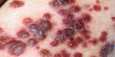This image shows Kaposi’s sarcoma, a skin cancer that is common amongst those with HIV.