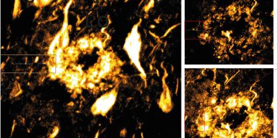An amyloid plaque in brain tissue shown by yellow swirls on a black background. Blue lines on the right show where a thin membrane was cut using technology at Leeds.